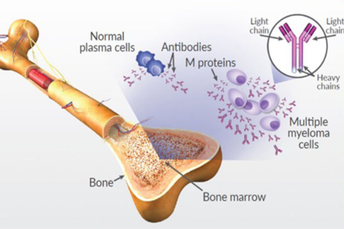 Multiple Myeloma - Dr Rashmi Bande (Yawalkar) - Best Hematologist In Nagpur